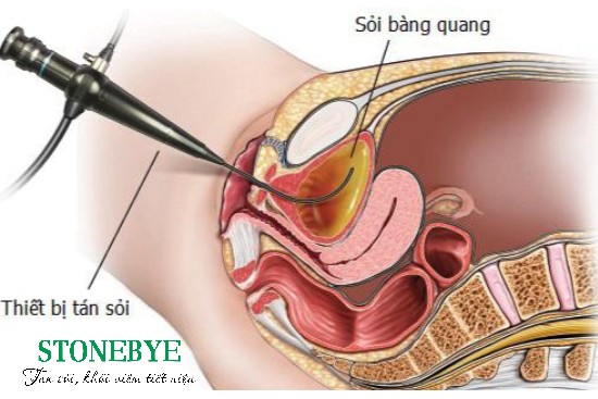 Tán sỏi bàng quang ở những bệnh viện uy tín sẽ đảm bảo an toàn và hiệu quả